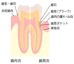歯周病